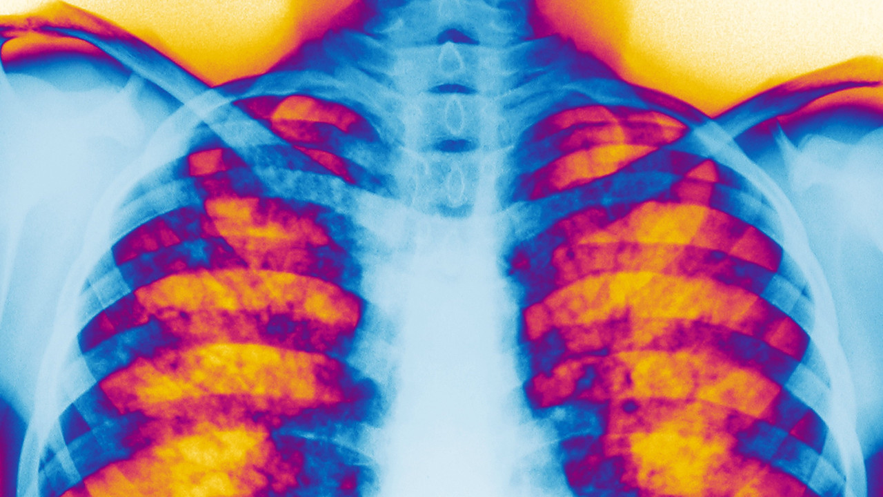 Rendgenski snimak pluća pacijenta sa cističnom fibrozom