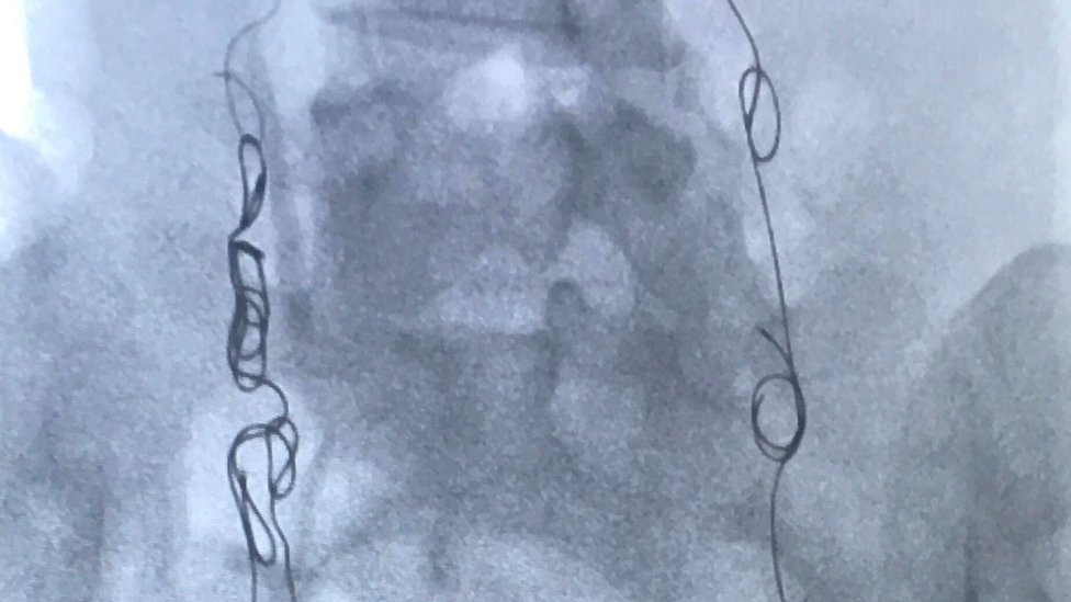 X-ray of Sophie Robehmed's embolisation