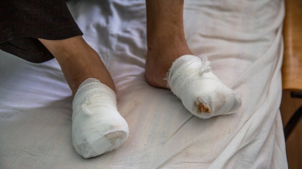 Nikita will have to relearn to walk after his toes were removed in Russia.