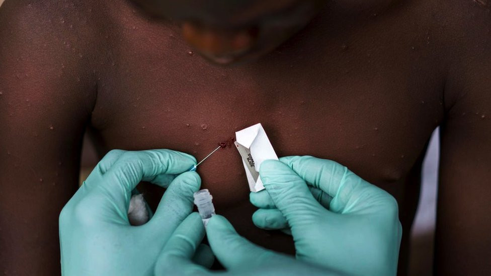 A teenage boy is suspected of suffering from the MonkeyPox virus in Manfuette, Republic of Congo Tuesday August 29, 2017.