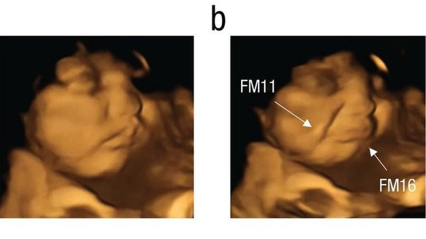 Image from FETAP study of a baby looking relaxed then of its face contorted
