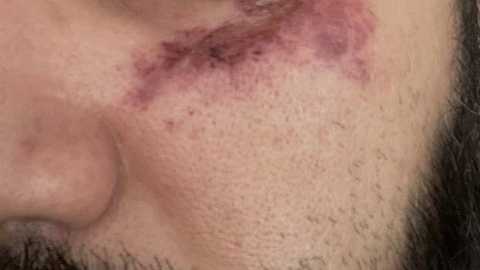 A close image showing bruising around the eye of a protester