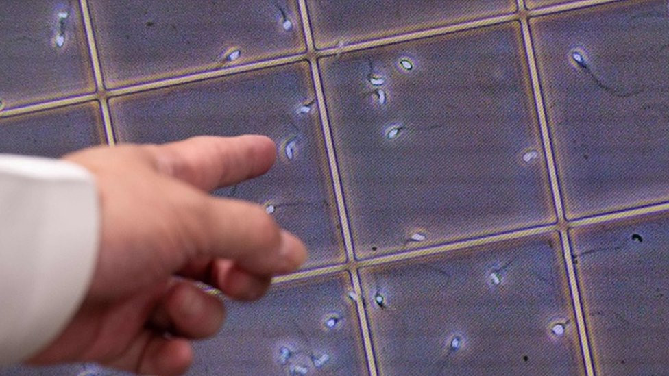 A medical professional points at a defective sperm under a microscope