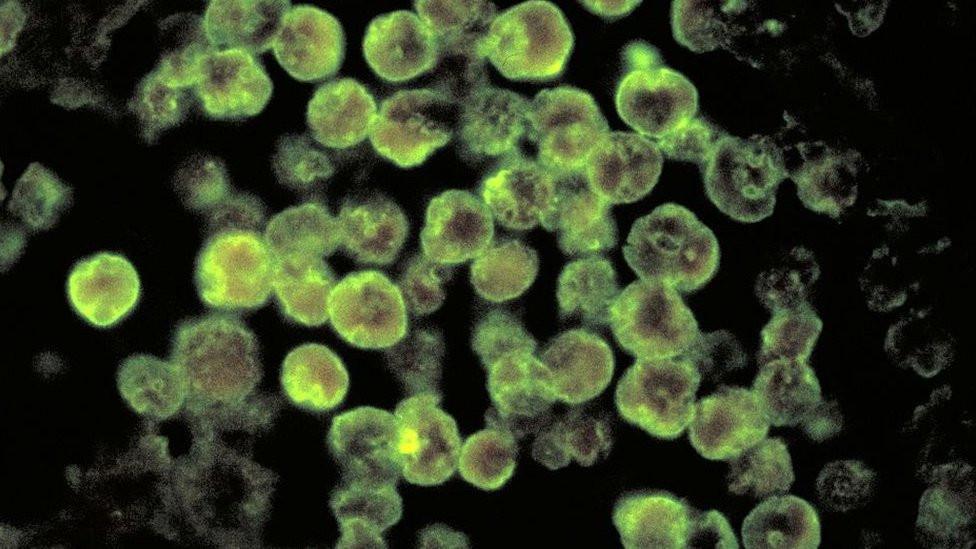 Microscopic view of a case of amebic meningoencephalitis due to Naegleria fowleri parasites