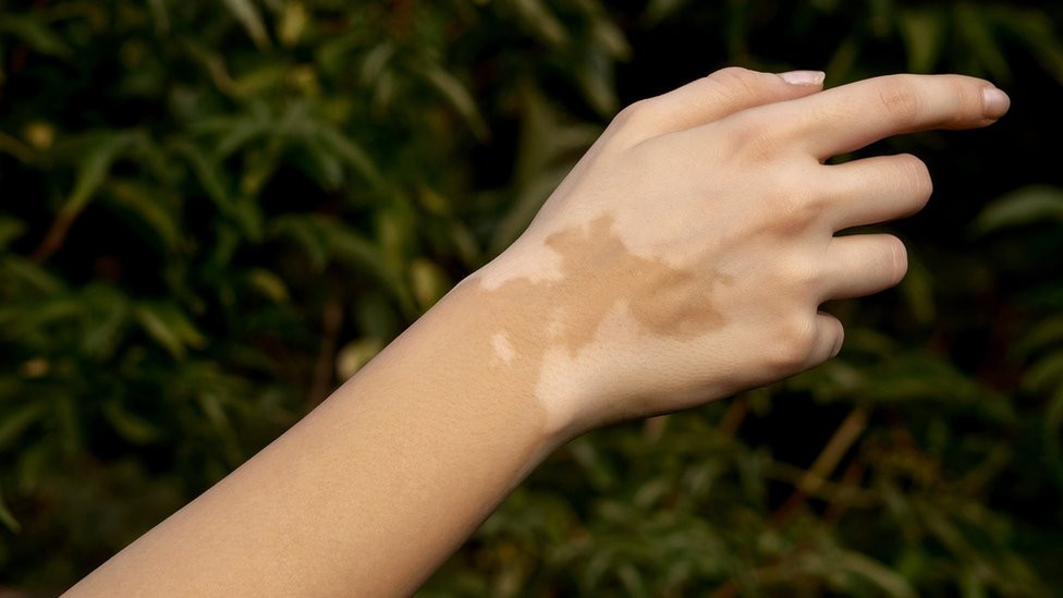 vitiligo