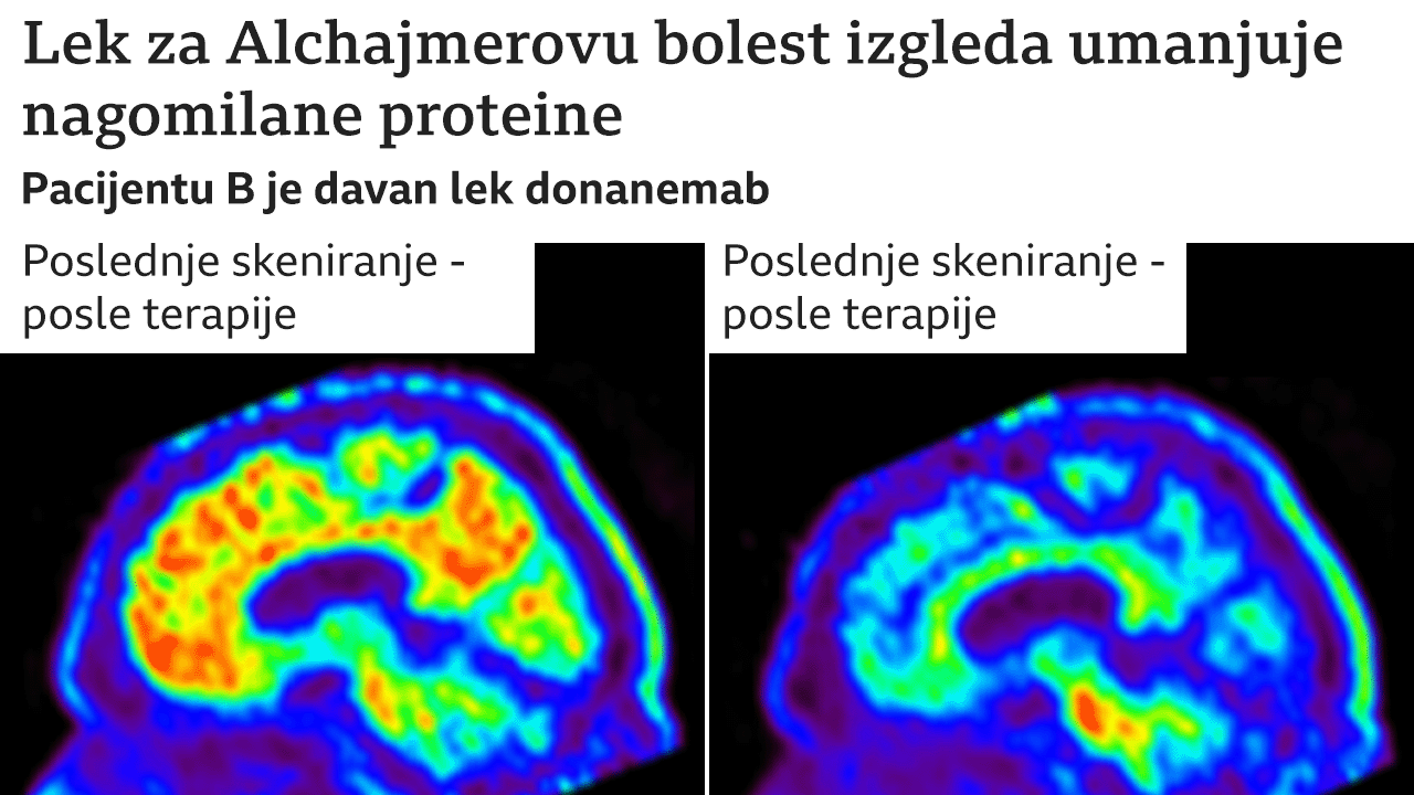 alchajmerova bolest, lek