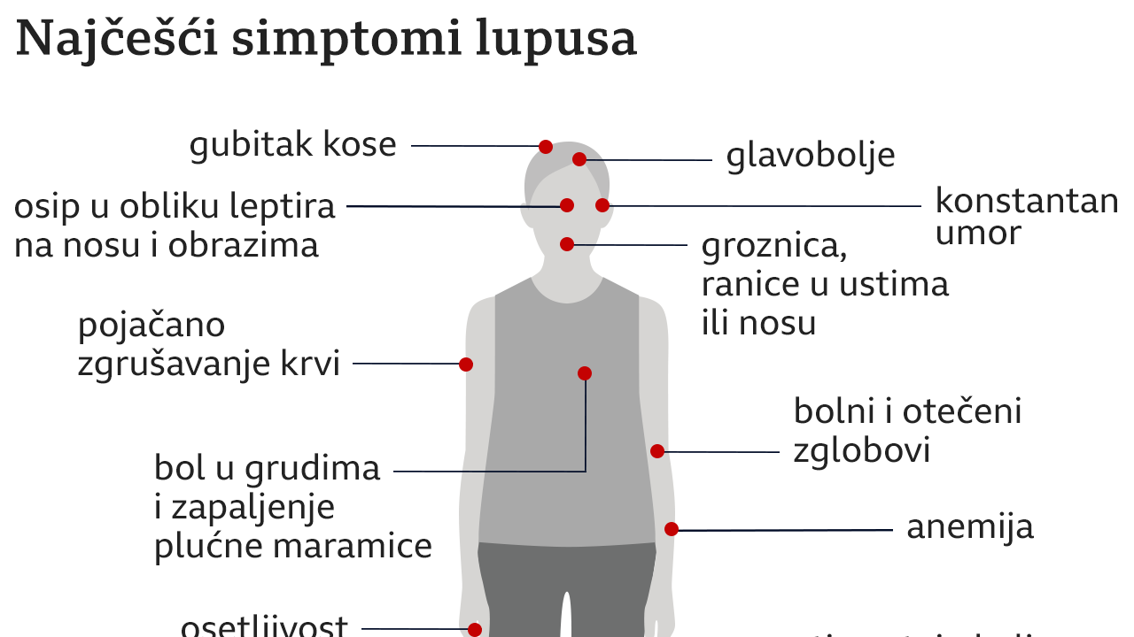 lupus, simptomi lupusa