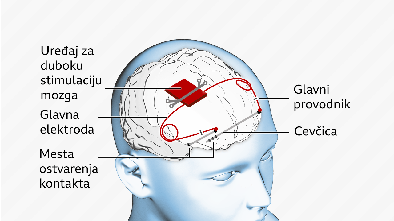 epilepsija, uređaj