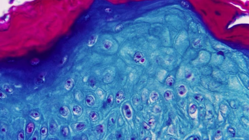 Under a microscope magnification of 500X, this image depicted a section of skin tissue, harvested from a lesion on the skin of a monkey, that had been infected with monkeypox virus, 1968. Courtesy CDC.