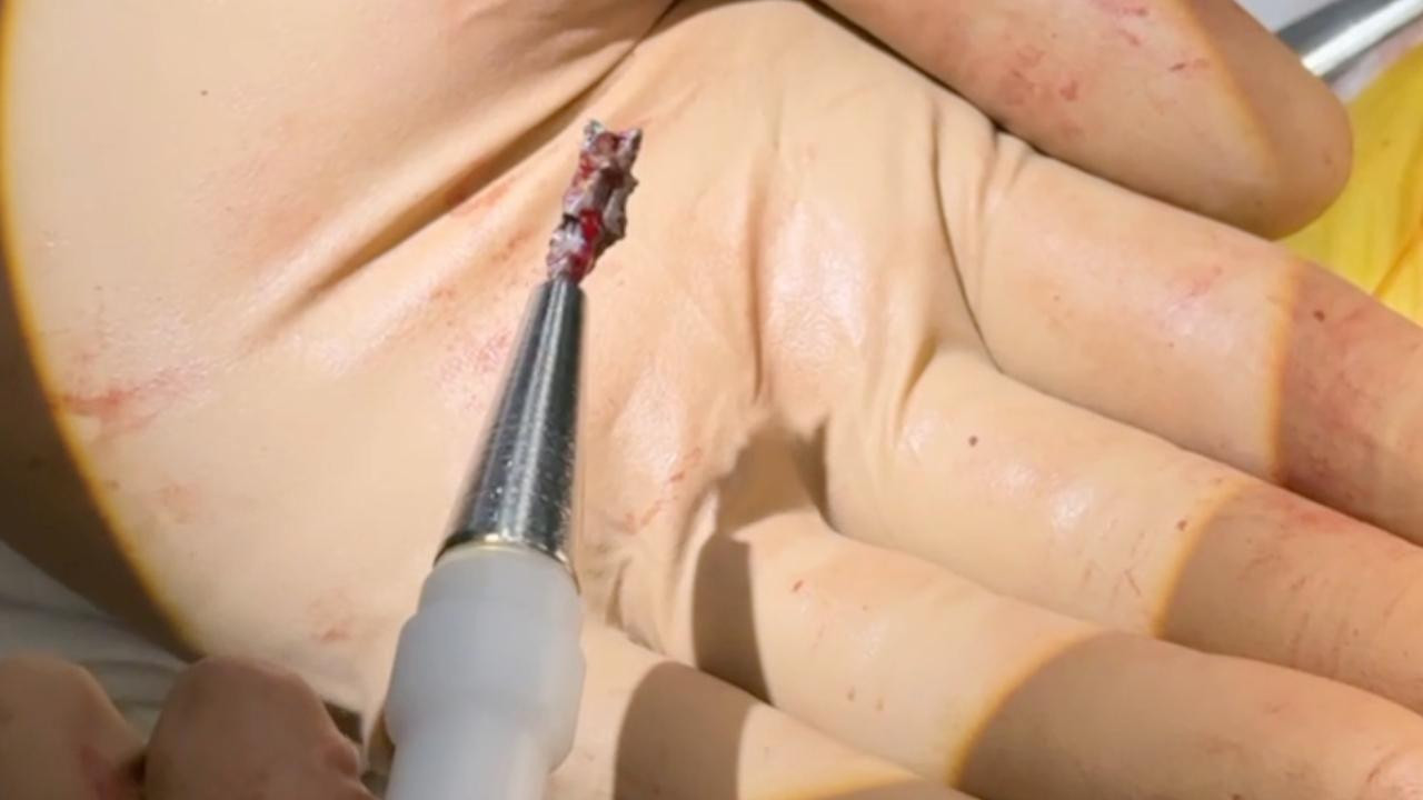 The shrapnel that was in Serhiy's heart attached to the magnetic extractor that removed it. 