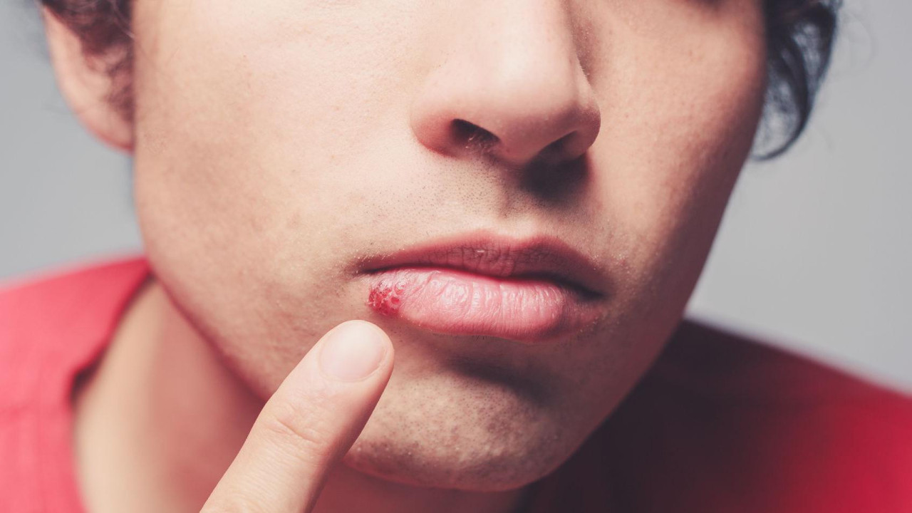 Virus herpesa je vrlo čest i može da dovede izazove rane od groznice kada se aktivira