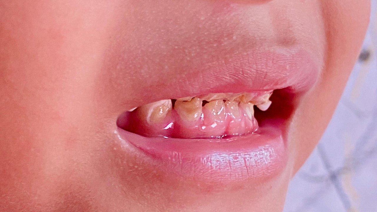 Pokvareni zubi kod dece