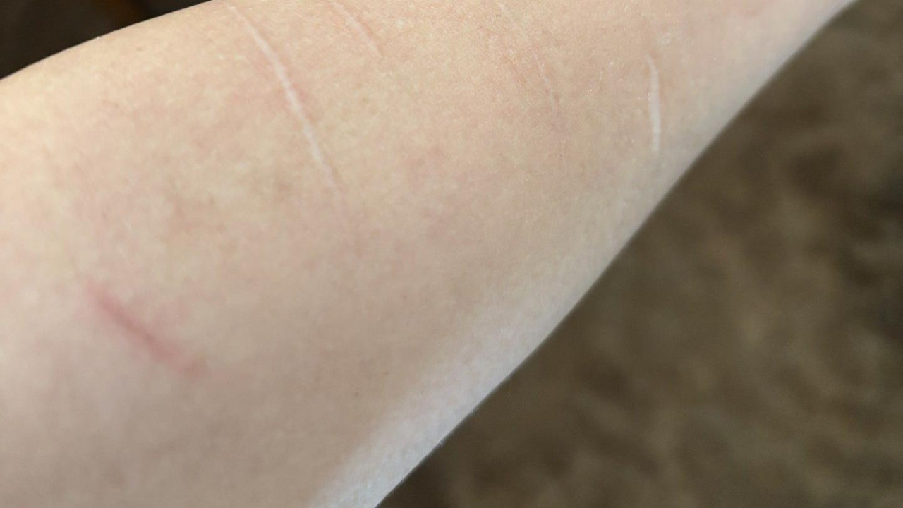 Ožiljci od samopovredjivanja