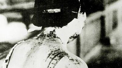 Žena pokazuje povrede od radijacije u Hirošimi - koža joj je spaljena u šari koja se poklapa sa tamnim delovima kimona nošenog u vreme eksplozije