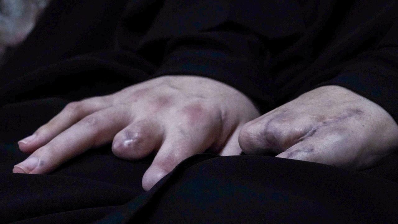 Najfine ruke su teško povređene u napadu pejdžerom