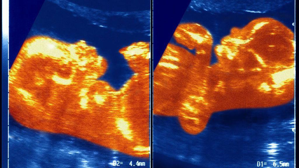 Ultrazvučni prikaz blizanaca