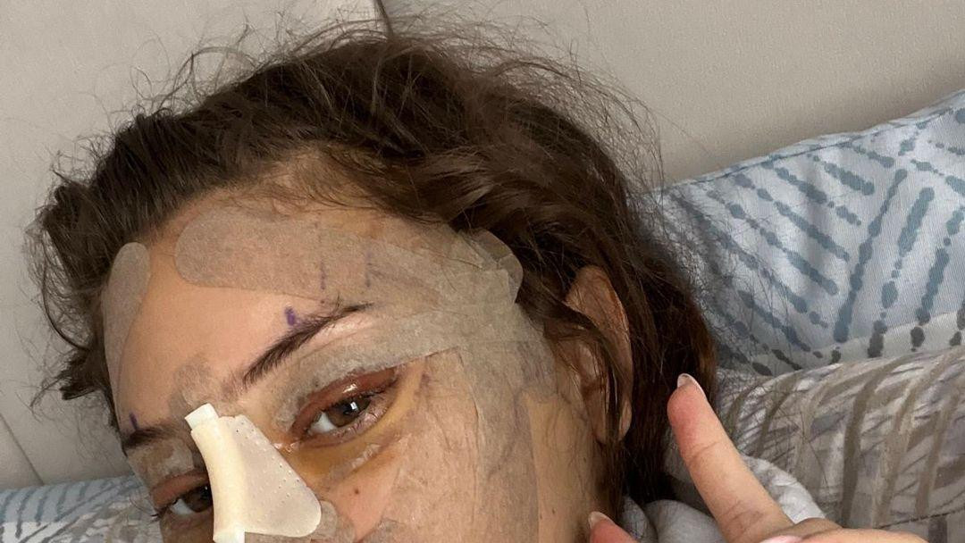 Emili posle operacije. Ima flastere preko obrva, obraza i nosa. Leži na krevetu i pokazuje znak V s dva prsta prema kameri.