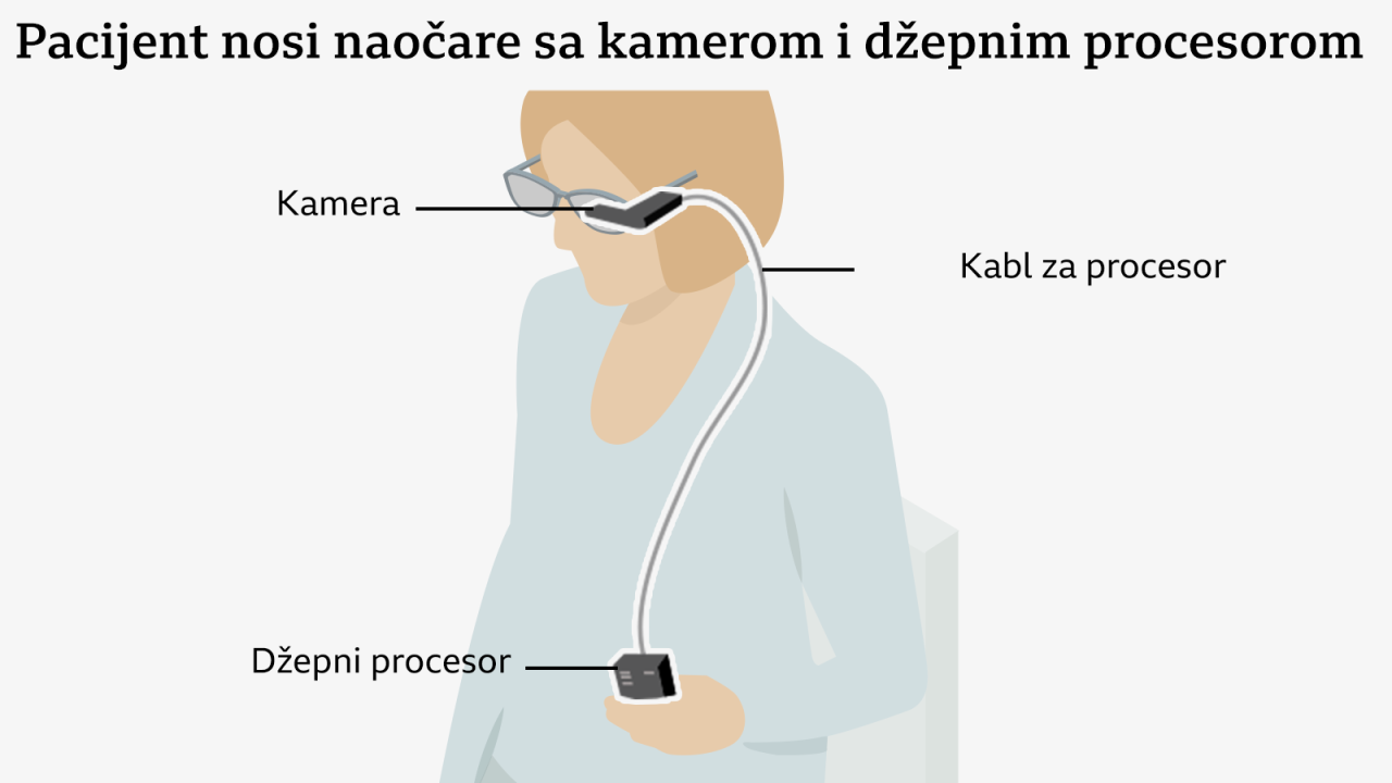 Grafika predstavlja kako tehnologija radi. Dat je prikaz pacijenta kome je ugrađen implant i koji nosi naočare sa ugrađenom video-kamerom i drži procesor povezan žicom sa naočarima. Ispod je ilustracija koja pokazuje kako kamera preko infracrvenog snopa šalje slike implantu u zadnjem delu oka. Uvećana slika oka prikazuje kako implant prima te infracrvene slike i potom ih prosleđuje crnom ručnom procesoru. Crvene strelice označavaju put slike - kako se šalju procesoru, poboljšavaju i vraćaju implantu i dalje u mozak. Treća grafika prikazuje način na koji se slike poboljšavaju: Levo je slika iz kamere koja prikazuje deo reči. Slova „ernoon” su crna na beloj pozadini i deluju malo zamućeno. Desno je poboljšana slika koju vidi pacijent, na kojoj su slova (sada bela) podebljana i uočljiva na crnoj pozadini. 
