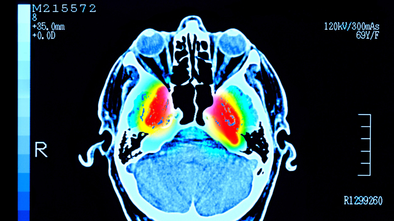Skeniranje ljudskog mozga prikazuje crvene oblasti oko centra, okružene žutim, zelenim i svetloplavim oblastima