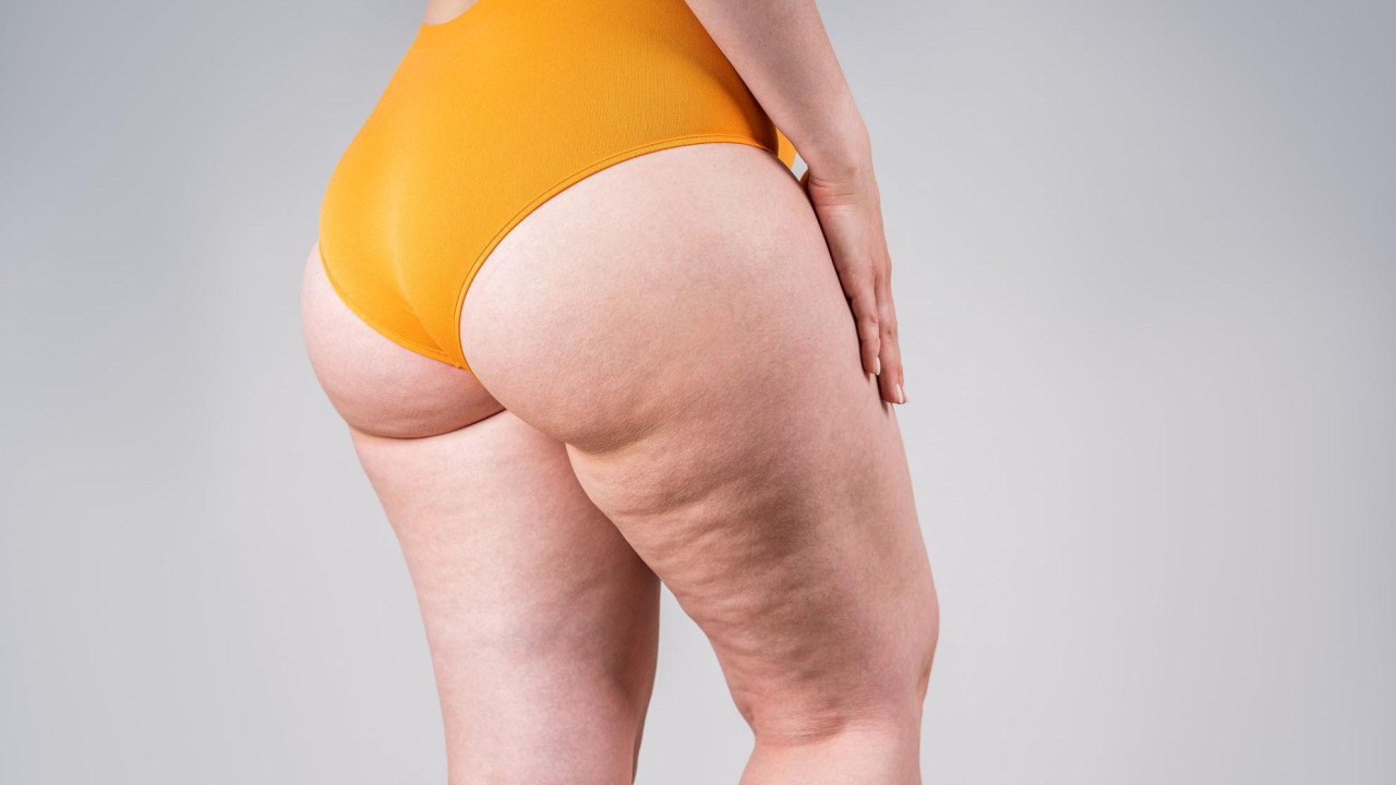 Žena u donjem vešu sa celulitom na nogama