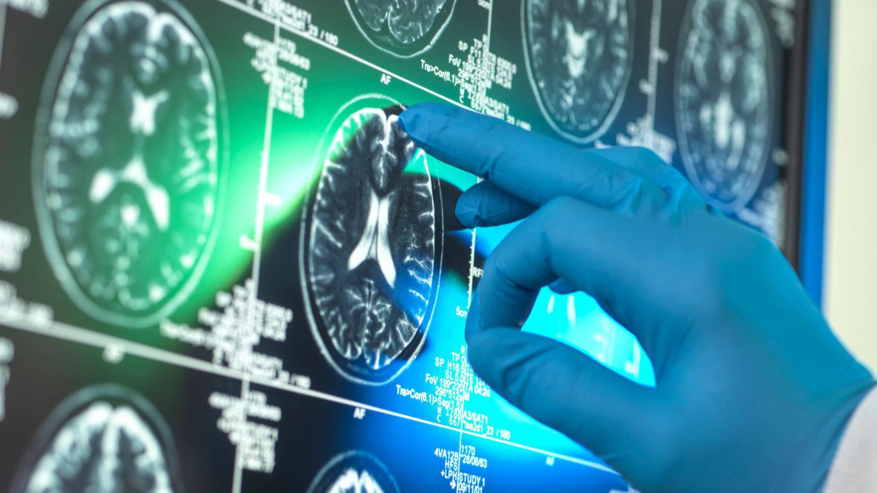 Ruka u plavoj rukavici srednjim prstom pokazuje na ekran na kojem je prikazuje kolekcija crno-belih skeniranih prikaza poprečnih preseka mozga