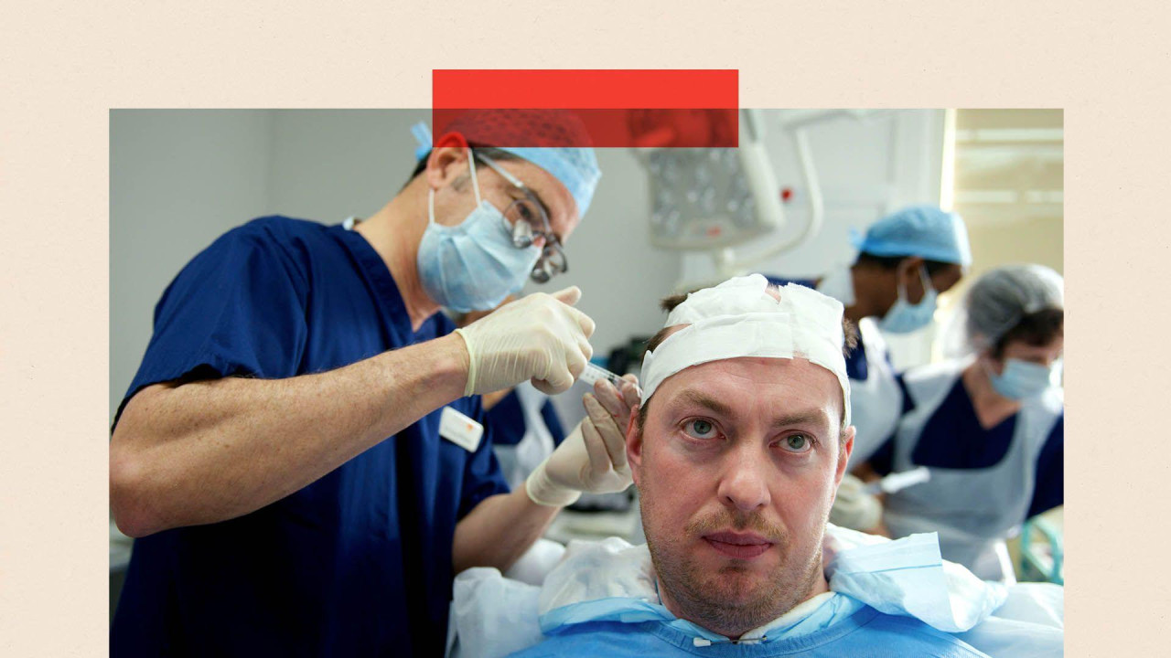 Muškarac sa zavojima na licu sedi u operacionoj sali i čeka dok mu medicinski tehničar ubrizgava folikule dlake