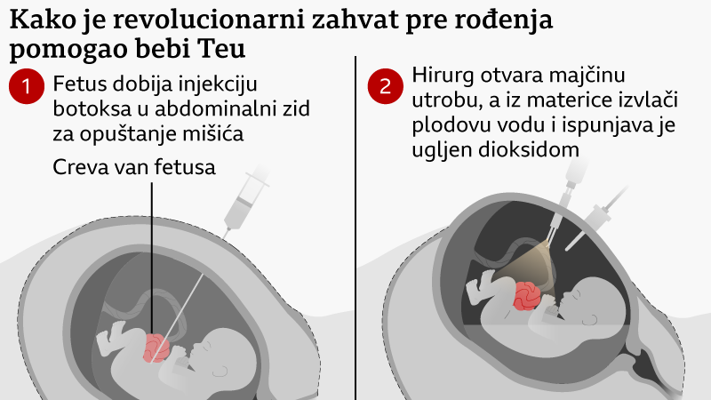 mapa fetusa u materici i načina na koji je izvedena operacija u četiri crteža