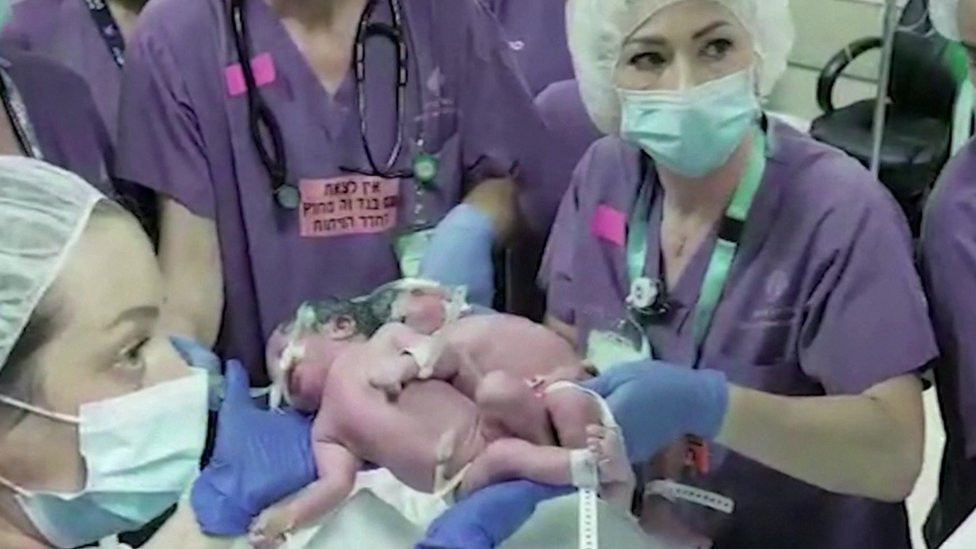Bliznakinje pre operacije